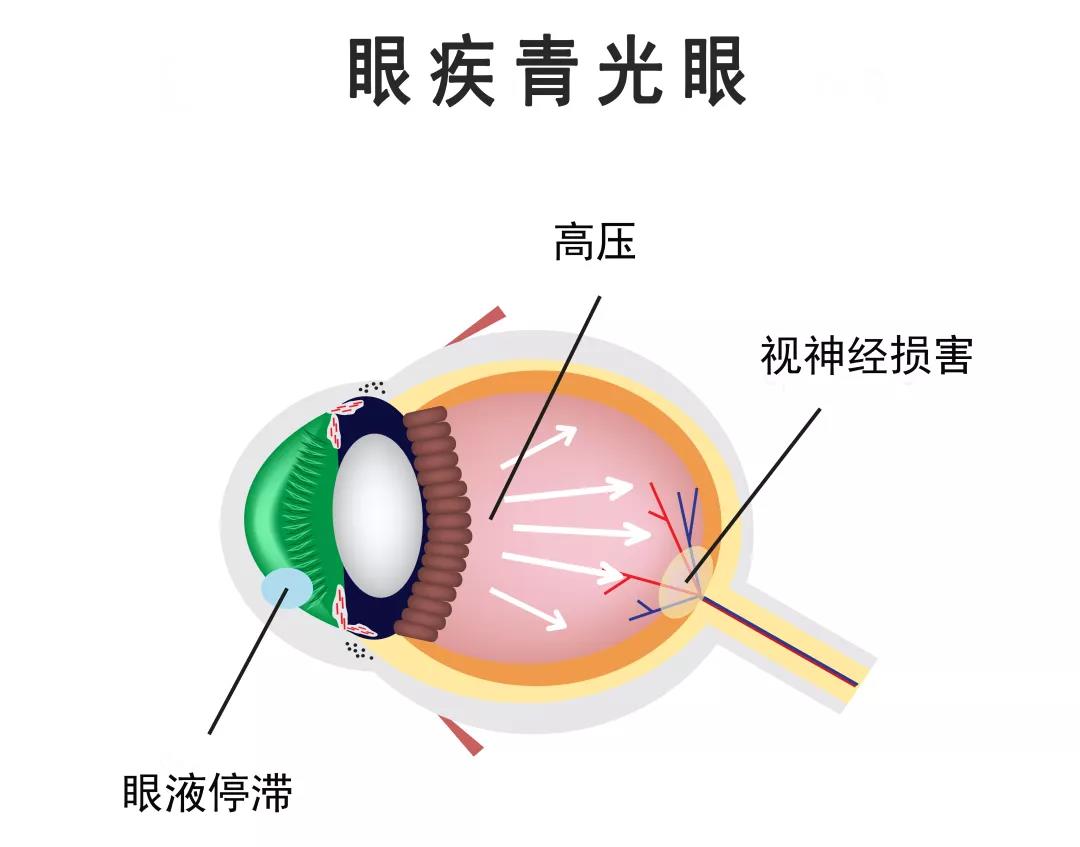 爱尔眼科医生提醒广大中老年人群:青光眼患者的眼睛有可能在一段较长